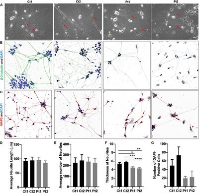 Human iPSC-Derived Neuronal Cells From CTBP1-Mutated Patients Reveal Altered Expression of Neurodevelopmental Gene Networks